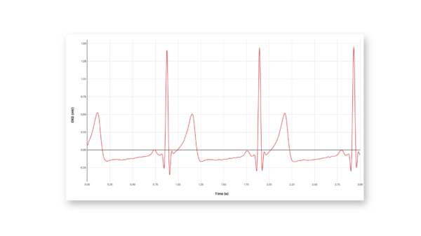 EKG recordings